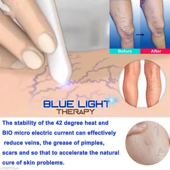 1 buc Medicale Portabile Lumină Albastră Terapie Acnee cu Laser Pen Pete pe Piele Îndepărtarea Pen Anti Varicoase Venoase Spider Eraser Tratament
