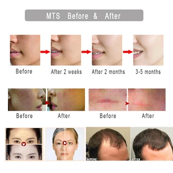 Derma roller DRS192 Mezoroller Real Micro Ac de Îngrijire a Pielii, Regenerarea Parului Creștere Barba Anti Caderea Parului Tratament Subțierea Indepartezi